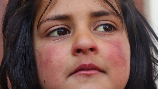 Jaundice outbreak has been reported at the Padgampora area of Awantipora block in South Kashmir’s Pulwama district, some 30 km's from Summer Capital Srinagar. Number of cases have been tested positive for the disease.Jaundice is a condition that causes yellowing of the skin and eyes.